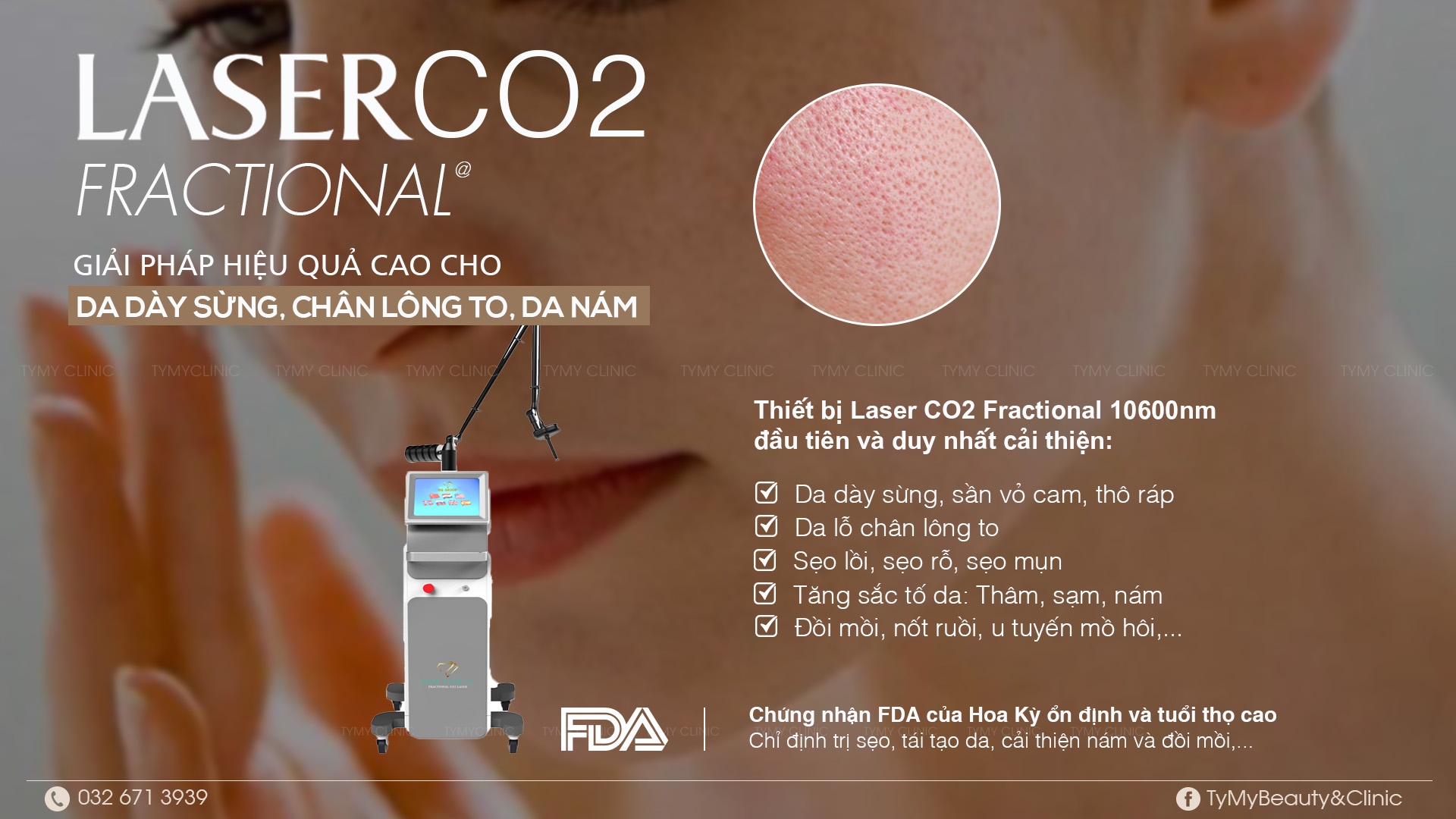 Laser Co2 - Trẻ hóa da dày sừng, thu nhỏ lỗ chân lông