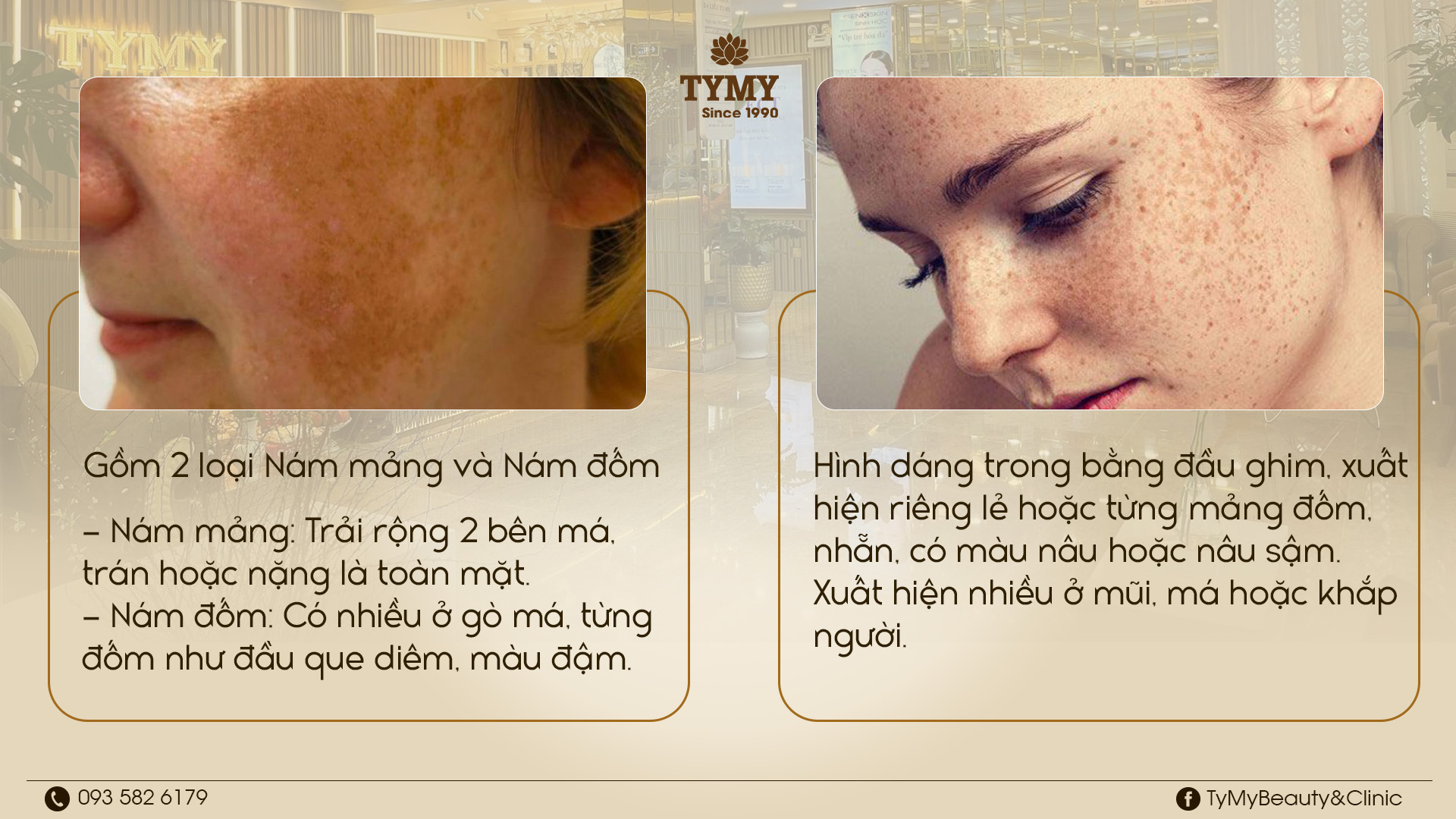 Phân biệt Nám - Tàn nhang để điều trị tốt nhất